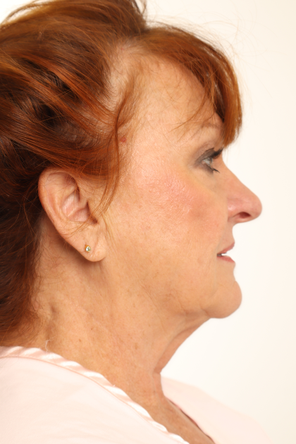 Rhinoplasty Before & After Patient #4302