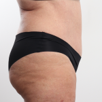 Tummy Tuck Before & After Patient #4304