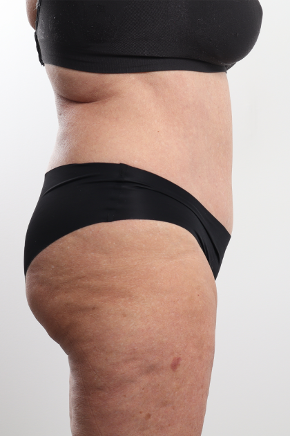 Tummy Tuck Before & After Patient #4304