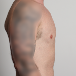 Gynecomastia Before & After Patient #4213