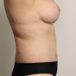Tummy Tuck Before & After Patient #4224