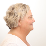MOXI Laser Before & After Patient #4254