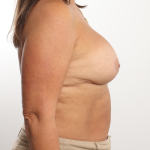 Breast Revision Before & After Patient #4257