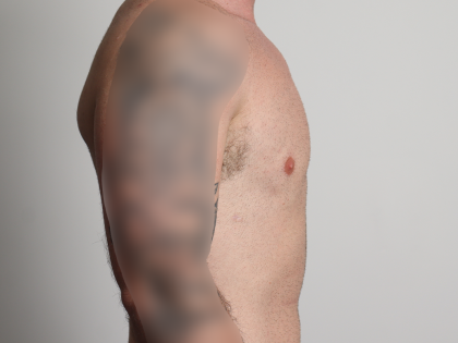 Gynecomastia Before & After Patient #4213