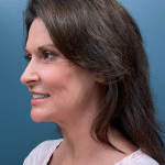 Facelift Before & After Patient #4293
