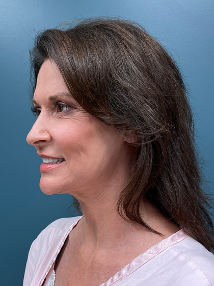 Facelift Before & After Patient #4293