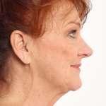 Rhinoplasty Before & After Patient #4302