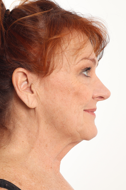 Rhinoplasty Before & After Patient #4302