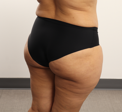 Brazilian Butt Lift Before & After Patient #4226