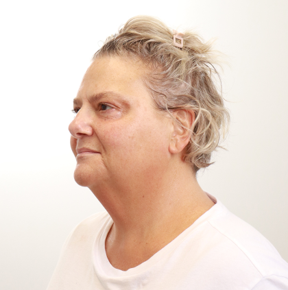 MOXI Laser Before & After Patient #4254