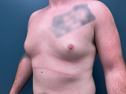 Gynecomastia Before & After Patient #4213
