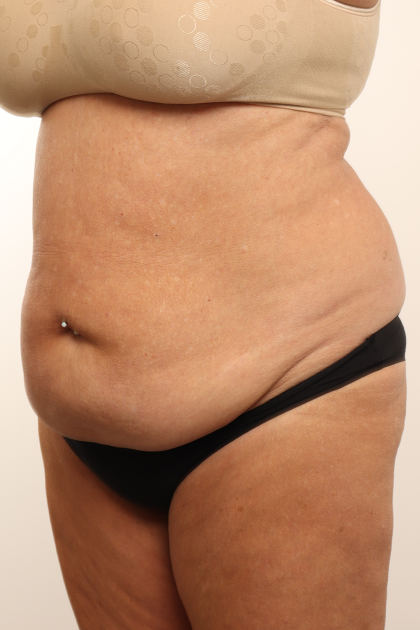 Tummy Tuck Before & After Patient #4304