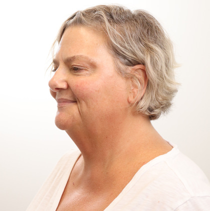 MOXI Laser Before & After Patient #4254