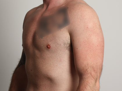 Gynecomastia Before & After Patient #4213
