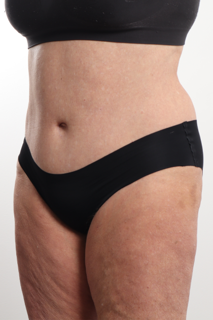 Tummy Tuck Before & After Patient #4304