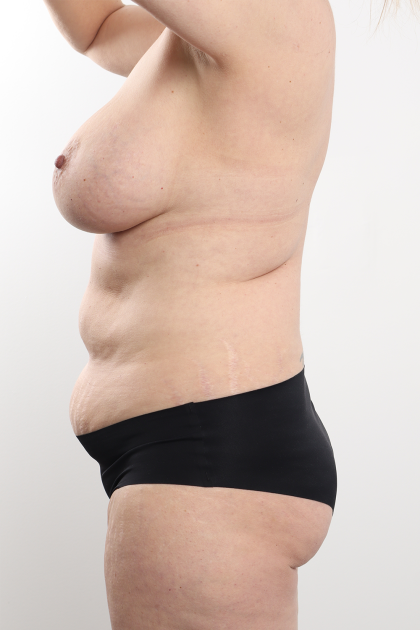 Tummy Tuck Before & After Patient #4224