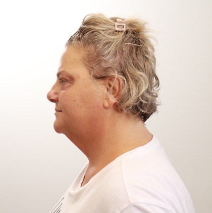 MOXI Laser Before & After Patient #4254