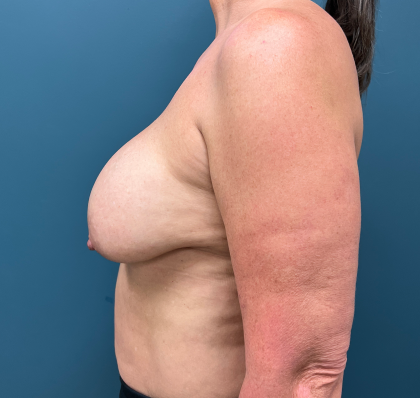 Breast Revision Before & After Patient #4257