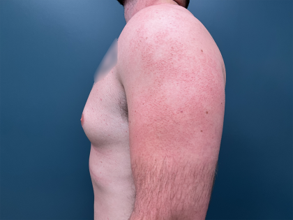 Gynecomastia Before & After Patient #4213