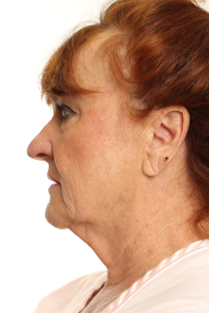 Rhinoplasty Before & After Patient #4302