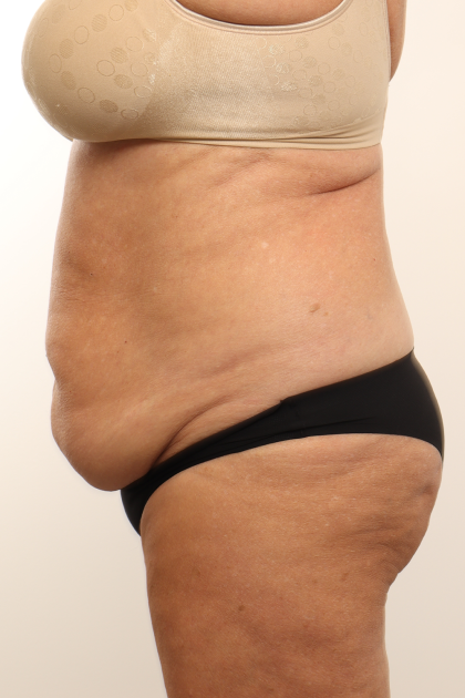Tummy Tuck Before & After Patient #4304
