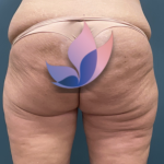 alloClae Before & After Patient #4400