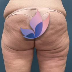 alloClae Before & After Patient #4400