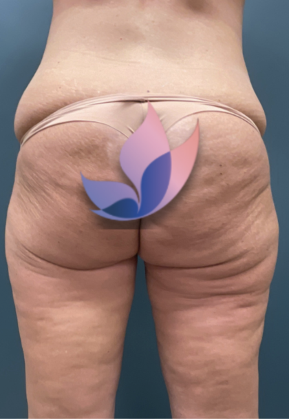 alloClae Before & After Patient #4400