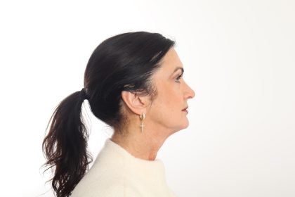 Facelift Before & After Patient #4389