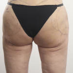 alloClae Before & After Patient #4400