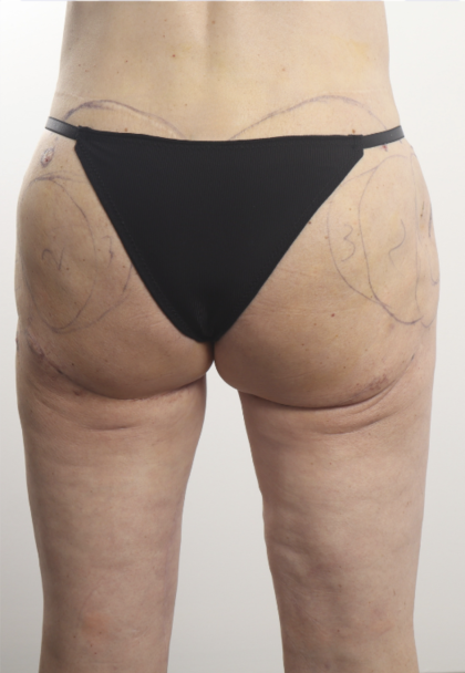 alloClae Before & After Patient #4400