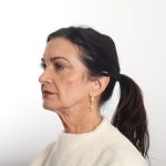 Facelift Before & After Patient #4389