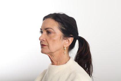 Facelift Before & After Patient #4389