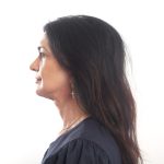Facelift Before & After Patient #4389