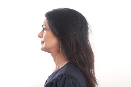 Facelift Before & After Patient #4389