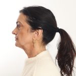Facelift Before & After Patient #4389