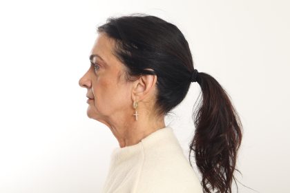 Facelift Before & After Patient #4389