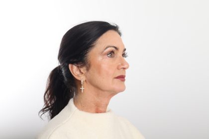 Facelift Before & After Patient #4389