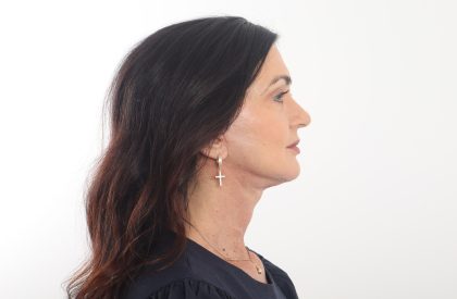 Facelift Before & After Patient #4389