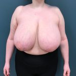 Breast Reduction Before & After Patient #4416