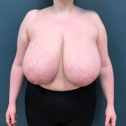 Breast Reduction Before & After Patient #4416