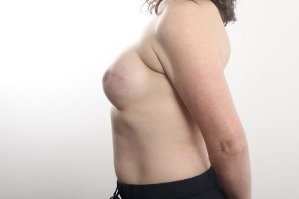 Breast Reconstruction Before & After Patient #4426