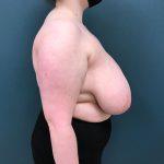 Breast Reduction Before & After Patient #4416