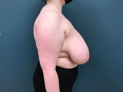 Breast Reduction Before & After Patient #4416