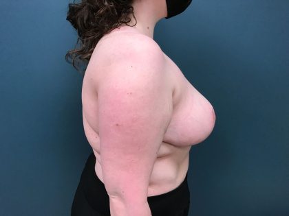 Breast Reduction Before & After Patient #4416