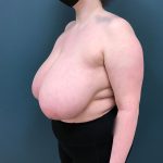 Breast Reduction Before & After Patient #4416