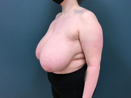 Breast Reduction Before & After Patient #4416