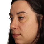Blepharoplasty Before & After Patient #4437