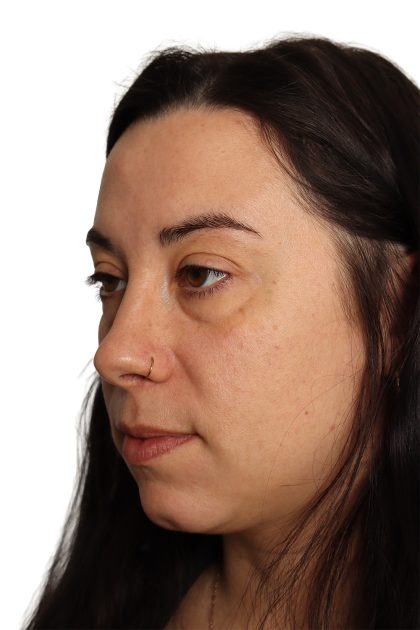 Blepharoplasty Before & After Patient #4437