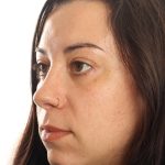 Blepharoplasty Before & After Patient #4437